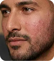 Same patient with acne marks before treatment