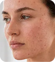 Same patient with acne before treatment