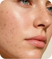 Same patient with inflamed skin before treatment