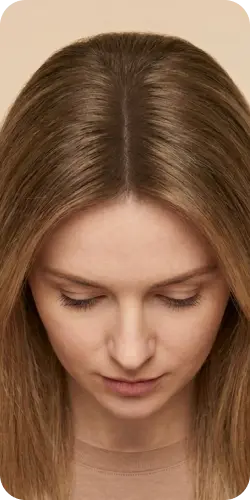 Same patient after treatment with fuller hair